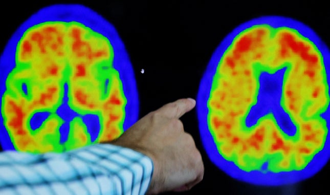 Um dedo aponta para uma varredura do cérebro com evidência da doença de Alzheimer